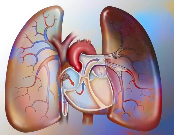 Эмболия легких. Кровяной сгусток достигает сердца через порез вены и направляется, с кровотоком, в легкие. Будучи слишком большим, чтобы циркулировать в все более узких кровеносных сосудах, этот тромб будет препятствовать определенным артериолам легких