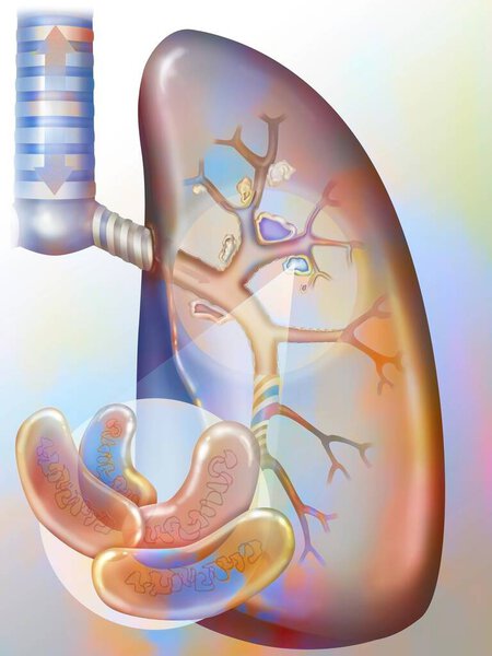 Легочный туберкулез. Бациллы Коха колонизируют легкие и развиваются, разрушая ткани, формируя очаги (caseum). Эти очаги кальцифицируются, образуя пещеры, в которых размножаются бактерии, и которые сохраняются после восстановления. 