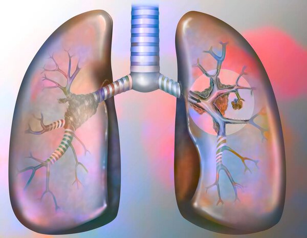 Рак легких курильщика (с наличием депозитов смолы в бронхах), медицинская иллюстрация анатомии человека