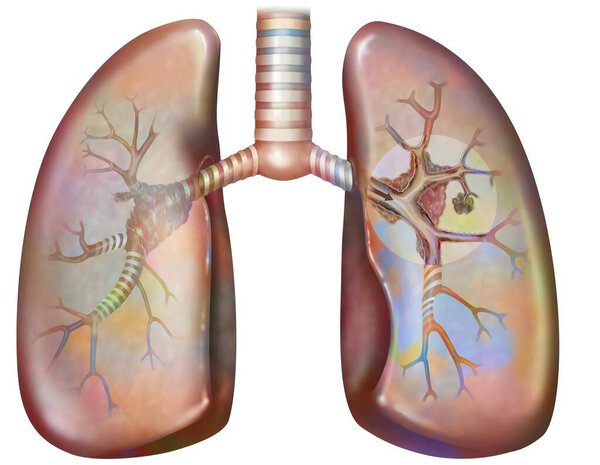 Рак легких курильщика (с наличием депозитов смолы в бронхах).