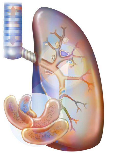 Легочный туберкулез. Бациллы Коха колонизируют легкие и развиваются, разрушая ткани, формируя очаги (caseum). Эти очаги кальцифицируются, образуя пещеры, в которых размножаются бактерии, и которые сохраняются после восстановления. 