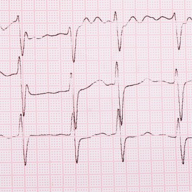 bir adamın kardiyogram bandıyla