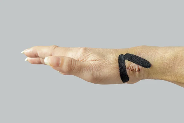 Fresh Healing Scar Hand Surgery Tendons Nerve Medical Black Elastic — Stock Photo, Image