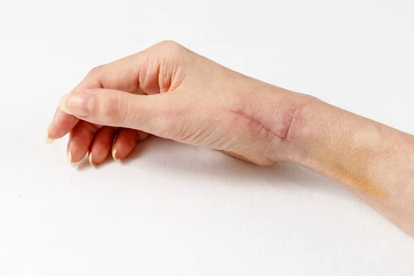 Fresh Healing Scar One Month Surgery Tendons Radial Nerve Scar — Stock Photo, Image