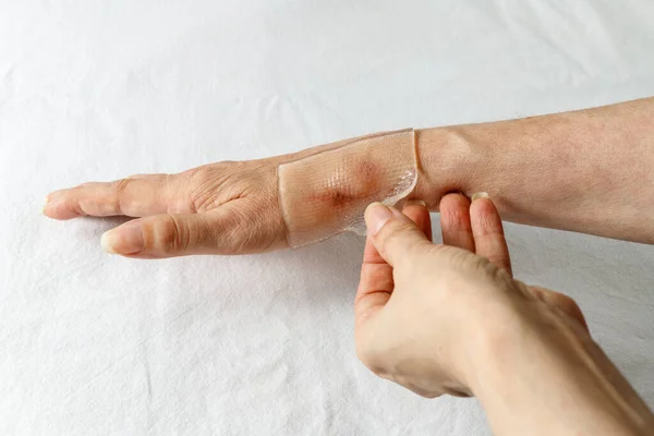 Bir kadının elindeki tendon ameliyatından sonra özel bir tıbbi yapıştırıcı silikon jel kağıdını iyileşme yarasına uygulamak. Esneklik için yara izi bakımı. Tedavi yeni hipertrofik veya keloid yaraları