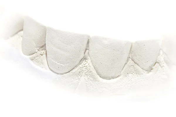 Dental gypsum model cast. — Stock Photo, Image