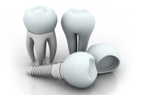 Implante dental — Foto de Stock