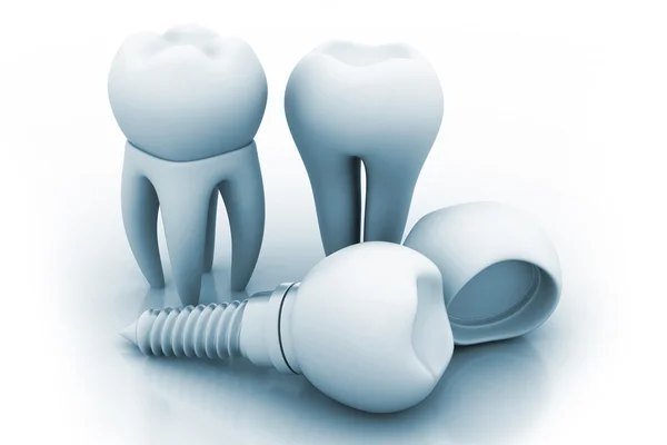 Diş implantı — Stok fotoğraf