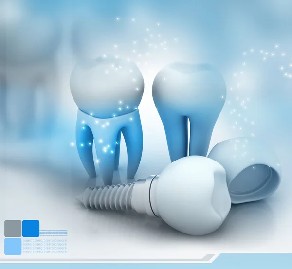 Dental Implant — Stock Photo, Image