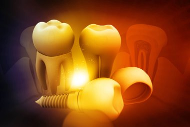 diş implantı