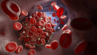 Depiction of a blood clot forming inside a blood vessel. 3D illustration clipart