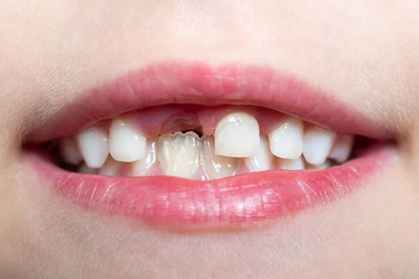 첫 번째 분실 된 치아를 보여 주는 아기 — 스톡 사진