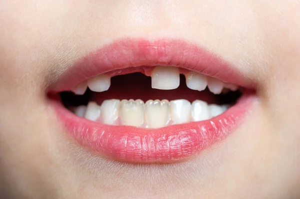 A criança mostra o primeiro dente perdido — Fotografia de Stock