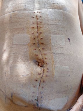 Ameliyat sonrası abdominal kesikler, iyileşme dikişleri ve görünür yara iyileşme süreci.
