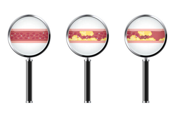 Кровеносные сосуды с векторной иллюстрацией атеросклероза