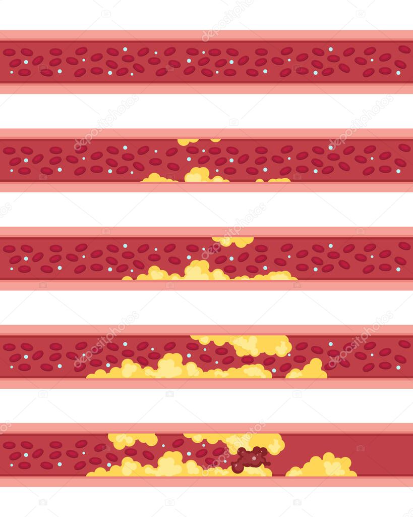 Phases of atherosclerosis vector illustration