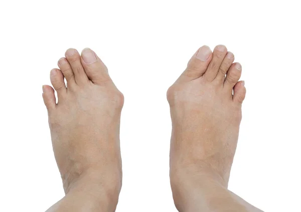 Hallux Valgus Juanete Pie Sobre Fondo Blanco — Foto de Stock