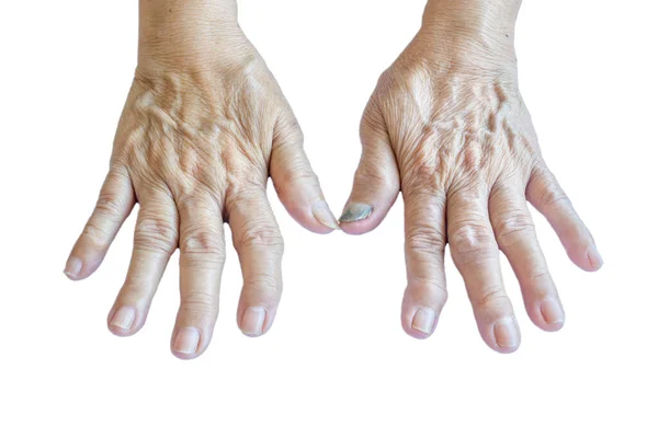 Χέρια Οστεοαρθρίτιδα Μιας Ηλικιωμένης Γυναίκας Λευκό Φόντο — Φωτογραφία Αρχείου