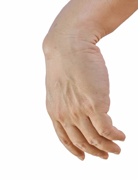 Ganglion Cysta Man Hand Isolerad Vit Bakgrund — Stockfoto