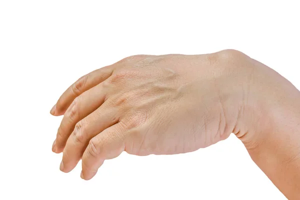 Ganglion Cysta Man Hand Isolerad Vit Bakgrund — Stockfoto