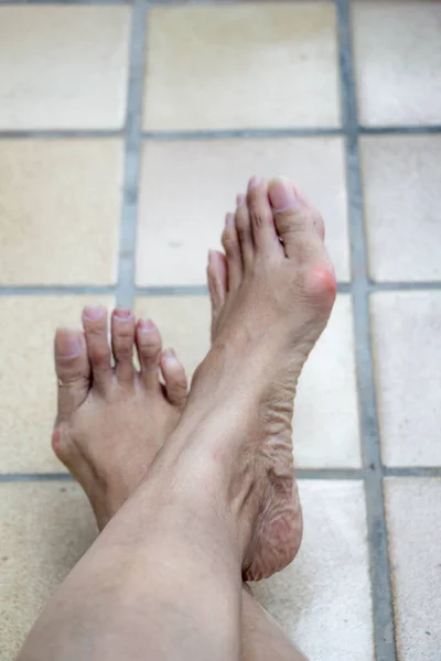 Hallux Valgus Οστό Στο Πόδι Της Γυναίκας — Φωτογραφία Αρχείου