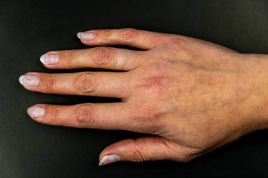 Siyah bir arka planda kadın elinin tırnak mantarı. İnsan vücudunun sağlığı ve hijyeni.