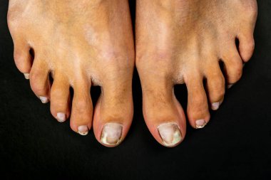 Siyah arka plandaki mantardan etkilenmiş kadın ayaklarının yakın çekimi. Ayak sağlığı ve hijyen.