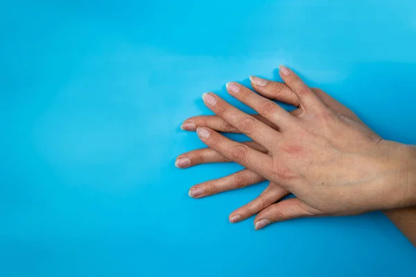 Female hands with nails affected by fungus on a blue background. Hand health and hygiene. Free space for text.