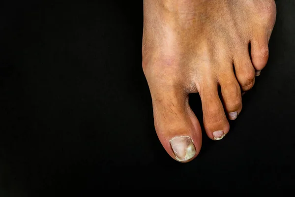 Toes Female Foot Close Nails Affected Fungus Black Background Foot — Stock Photo, Image