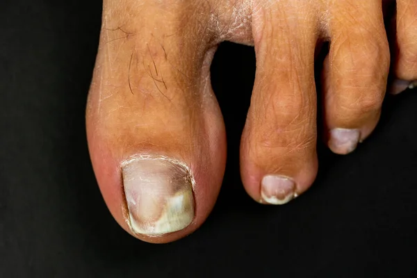 Toes Female Foot Close Nails Affected Fungus Black Background Foot — Stock Photo, Image