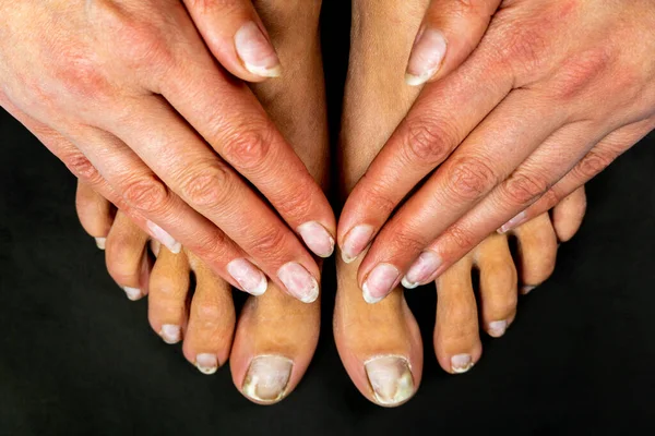 Жіночі Руки Ноги Крупним Планом Цвяхами Ураженими Грибком Чорному Тлі — стокове фото