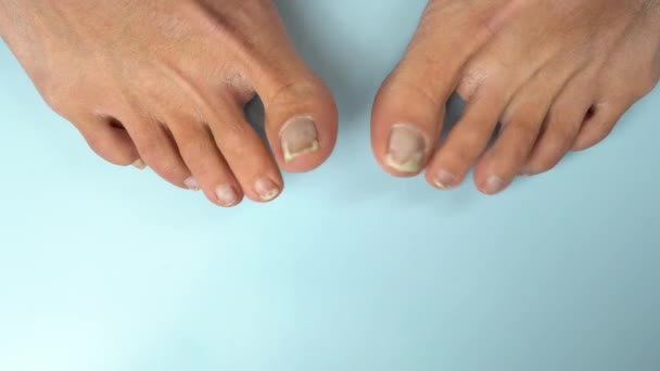 Danza Uñas Los Pies Hongos Las Mujeres Uñas Los Pies — Vídeo de stock