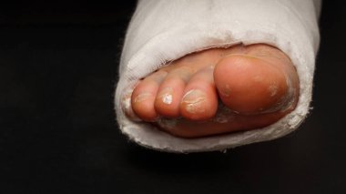 Siyah arkaplanda alçılı bir erkek bacağı ve kopyalama alanı. Bandaja sarılı ayak bileğinin yakın çekimi.