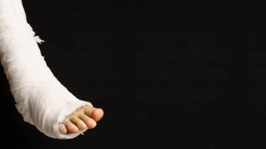 Bacağında alçı var. Adam bacağını kırmış ve siyah arka planda fotokopi alanı olan alçılı bir ayağı var.