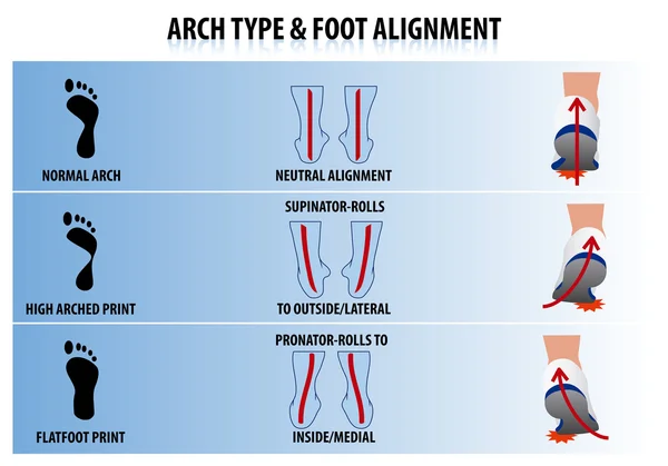 Arch Type and Foot Alignment — Stock Vector