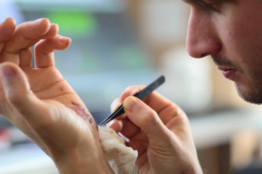 Avuç içlerindeki sıyrıklar ve yetişkin bir adamın sağ kolundaki çizikler. Ev tedavisi.