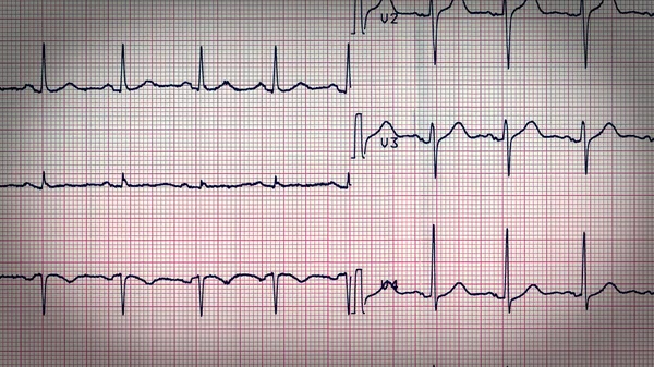 Aspetto retrò Elettrocardiografia del battito cardiaco — Foto Stock