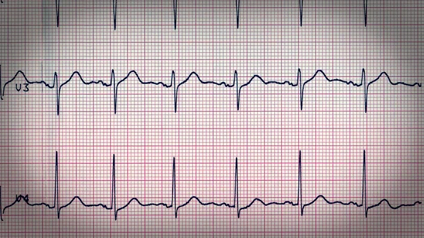 Olhar retrô Eletrocardiografia do batimento cardíaco — Fotografia de Stock