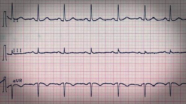 Olhar retrô Eletrocardiografia do batimento cardíaco — Fotografia de Stock