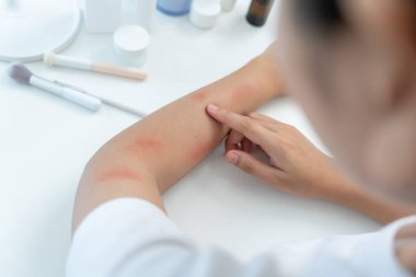 Cilt sorunu ve güzellik. Cilt alerjisi, steroid alerjisi, hassas cilt, güneş yanığı, kimyasal alerji, isilik, böcek ısırığı, Seborrheic Dermatitis..