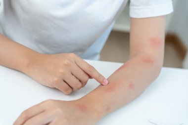 Cilt sorunu ve güzellik. Cilt alerjisi, steroid alerjisi, hassas cilt, güneş yanığı, kimyasal alerji, isilik, böcek ısırığı, Seborrheic Dermatitis..