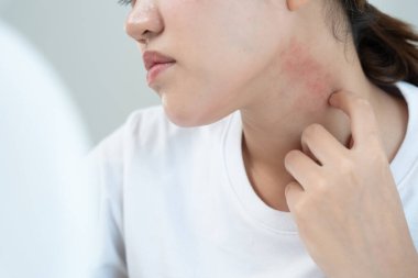 Cilt sorunu ve güzellik. Cilt alerjisi, steroid alerjisi, hassas cilt, güneş yanığı, kimyasal alerji, kızarıklık, böcek ısırıkları, Seborrheic Dermatitis.