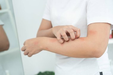 Cilt sorunu ve güzellik. Cilt alerjisi, steroid alerjisi, hassas cilt, güneş yanığı, kimyasal alerji, isilik, böcek ısırığı, Seborrheic Dermatitis..