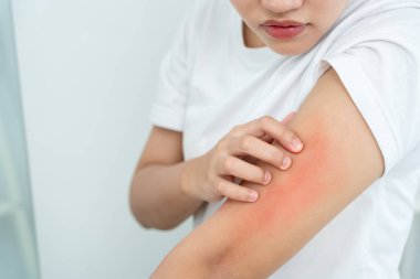 Cilt sorunu ve güzellik. Cilt alerjisi, steroid alerjisi, hassas cilt, güneş yanığı, kimyasal alerji, isilik, böcek ısırığı, Seborrheic Dermatitis..