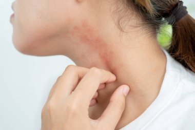 Cilt sorunu ve güzellik. Cilt alerjisi, steroid alerjisi, hassas cilt, güneş yanığı, kimyasal alerji, isilik, böcek ısırığı, Seborrheic Dermatitis..
