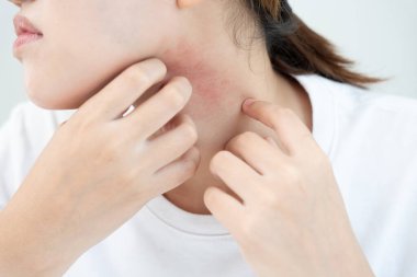 Cilt sorunu ve güzellik. Cilt alerjisi, steroid alerjisi, hassas cilt, güneş yanığı, kimyasal alerji, kızarıklık, böcek ısırıkları, Seborrheic Dermatitis..