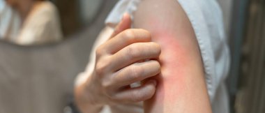 Cilt alerjisi, steroid alerjisi, hassas cilt, güneş yanığı, kimyasal alerji, isilik, böcek ısırığı, Seborrheic Dermatitis..