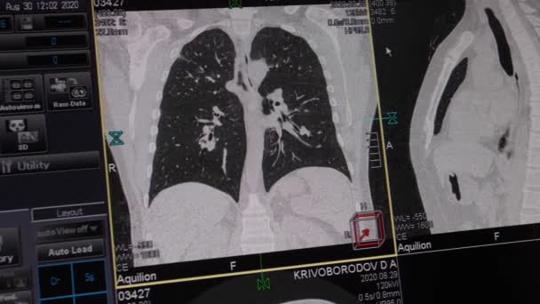 Volumineuze Mri Van Longen Bronchiën Diagnose Van Virale Covid Respiratoire — Stockvideo