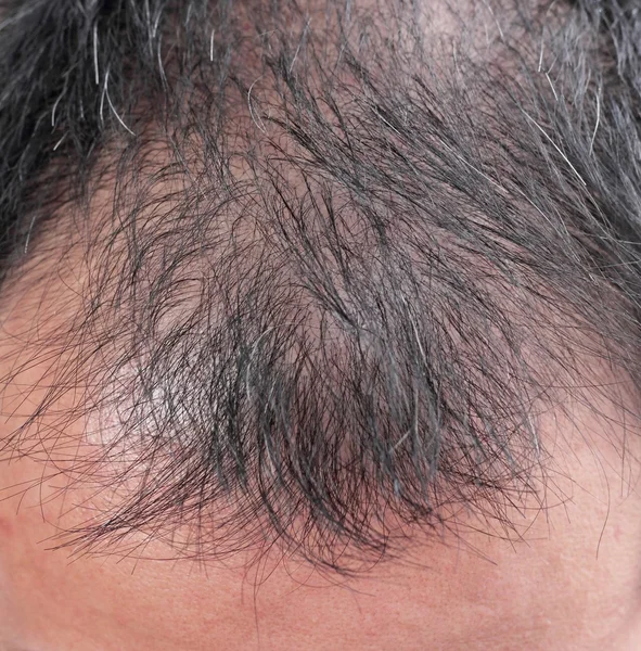 tüysüz keltoş kaybı saç çizgisi erkekler.