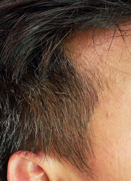 hair loss and grey hair.